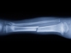 Fracture risk more important than bone density