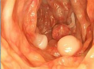 Colon cancer 'could surge among young'